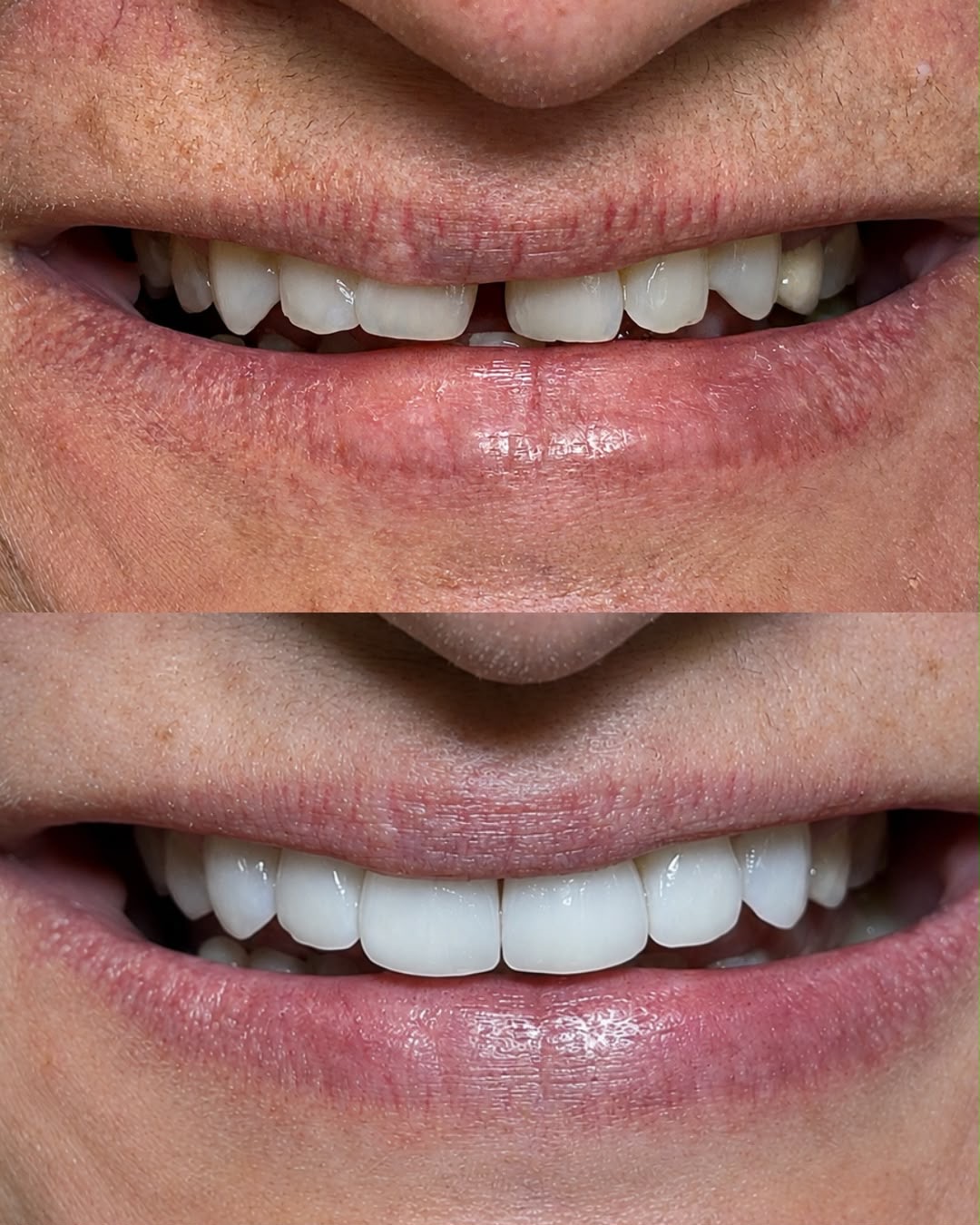 Antes e depois de tratamento com facetas